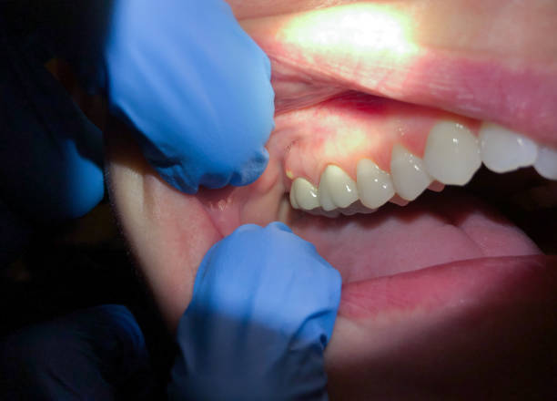 Best Dental Abscess Treatment in Cheswold, DE